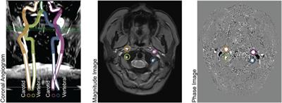 Imputation models and error analysis for phase contrast MR cerebral blood flow measurements